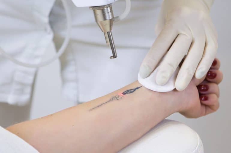 laser removing of a tattoo process