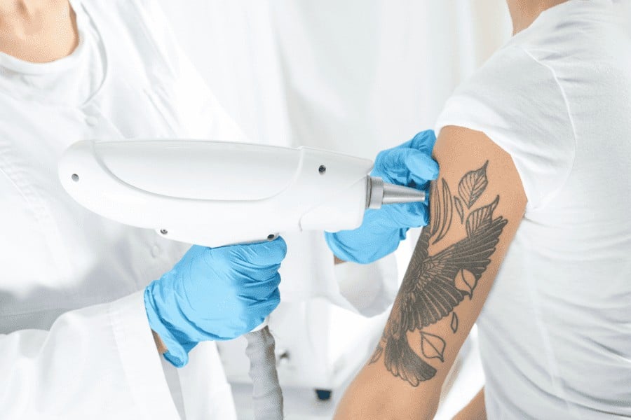 How To Prepare For Your Laser Tattoo Removal Treatment