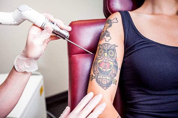 Tips for Planning a Laser Tattoo Removal Session